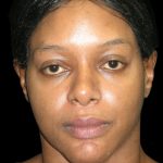 Rhinoplasty Before & After Patient #2812