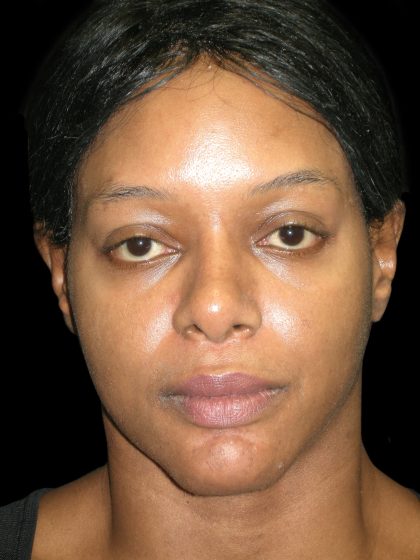 Rhinoplasty Before & After Patient #2812