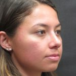 Rhinoplasty Before & After Patient #2798
