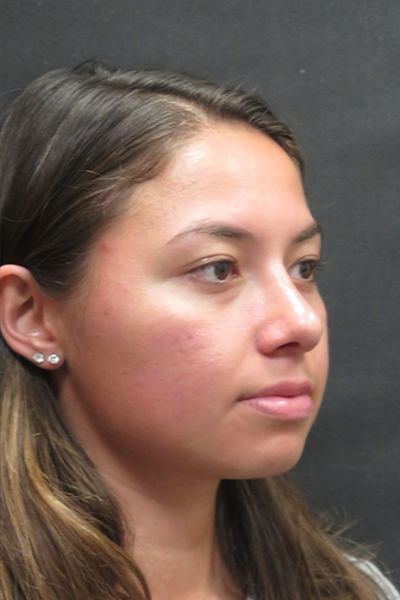 Rhinoplasty Before & After Patient #2798