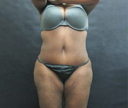 Mommy Makeover Before & After Patient #2503