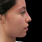 Rhinoplasty Before & After Patient #2863