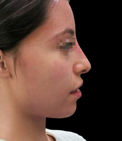 Rhinoplasty Before & After Patient #2863