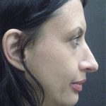 Rhinoplasty Before & After Patient #2877