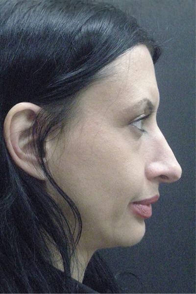 Rhinoplasty Before & After Patient #2877