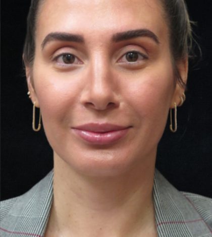 Rhinoplasty Before & After Patient #2851