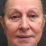 Rhinoplasty Before & After Patient #2891