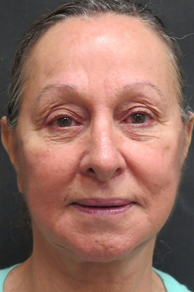 Rhinoplasty Before & After Patient #2891