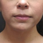 Chin Augmentation Before & After Patient #1561