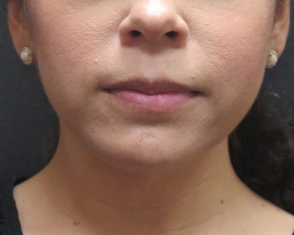 Chin Augmentation Before & After Patient #1561