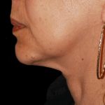 Chin Augmentation Before & After Patient #1566