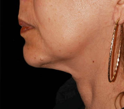 Chin Augmentation Before & After Patient #1566