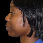Chin Augmentation Before & After Patient #1554