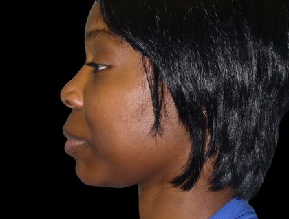Chin Augmentation Before & After Patient #1554