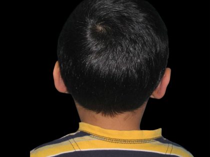 Ear Reshaping Before & After Patient #1572