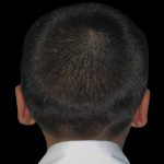 Ear Reshaping Before & After Patient #1569