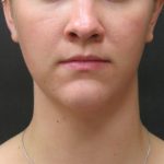 Fat Transfer Before & After Patient #1782