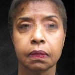 Fat Transfer Before & After Patient #1770