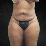 Mommy Makeover Before & After Patient #2587
