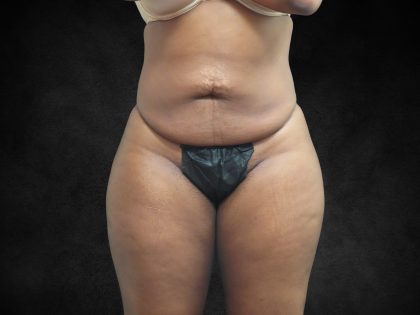 Mommy Makeover Before & After Patient #2587