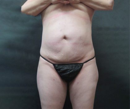 Mommy Makeover Before & After Patient #2563