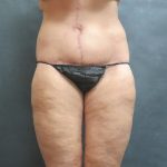 Thigh Lift Before & After Patient #3118