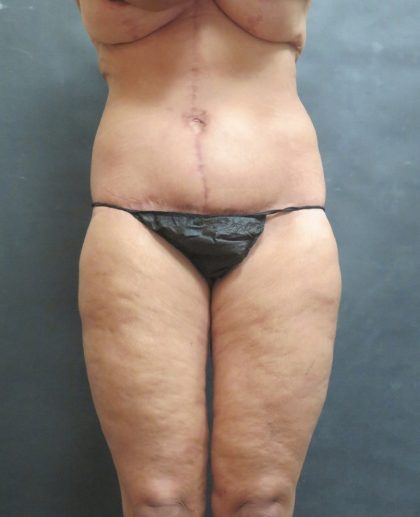 Thigh Lift Before & After Patient #3118