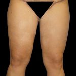 Thigh Lift Before & After Patient #3128