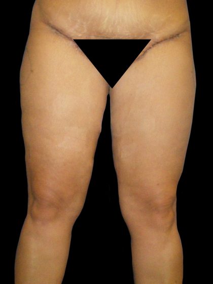 Thigh Lift Before & After Patient #3128