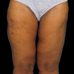Thigh Lift Before & After Patient #3137