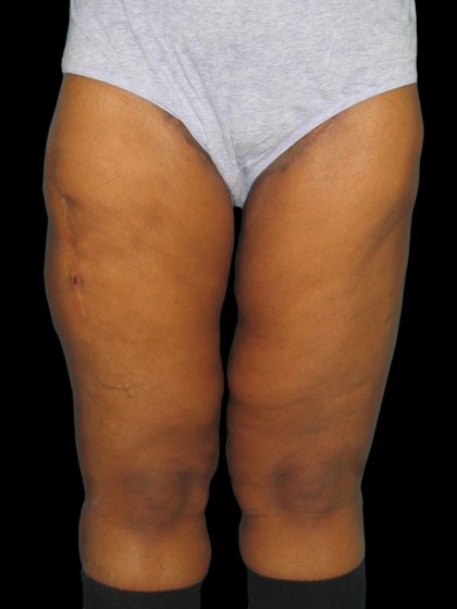 Thigh Lift Before & After Patient #3137