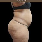 Liposuction Before & After Patient #2175