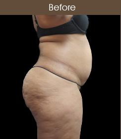 Liposuction Before & After Patient #2175