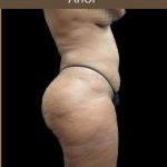 Liposuction Before & After Patient #2175