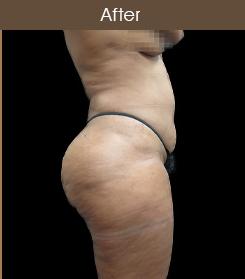 Liposuction Before & After Patient #2175