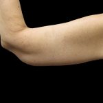 Arm Lift Before & After Patient #904