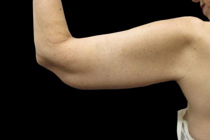 Arm Lift Before & After Patient #904