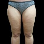 Thigh Lift Before & After Patient #3113