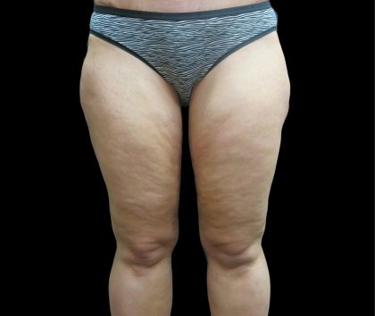Thigh Lift Before & After Patient #3113