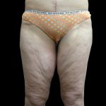 Thigh Lift Before & After Patient #3123