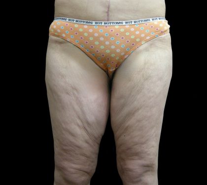 Thigh Lift Before & After Patient #3123