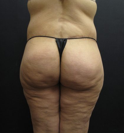 BBL / Brazilian Butt Lift / Gluteal Fat transfer Before & After Patient #1540