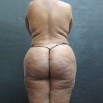 BBL / Brazilian Butt Lift / Gluteal Fat transfer Before & After Patient #1530