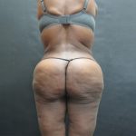 BBL / Brazilian Butt Lift / Gluteal Fat transfer Before & After Patient #1490