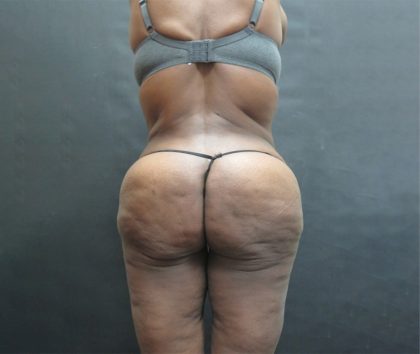 BBL / Brazilian Butt Lift / Gluteal Fat transfer Before & After Patient #1490