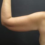 Arm Lift Before & After Patient #897