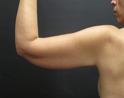 Arm Lift Before & After Patient #897