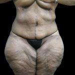 Post Weight Loss Before & After Patient #2749