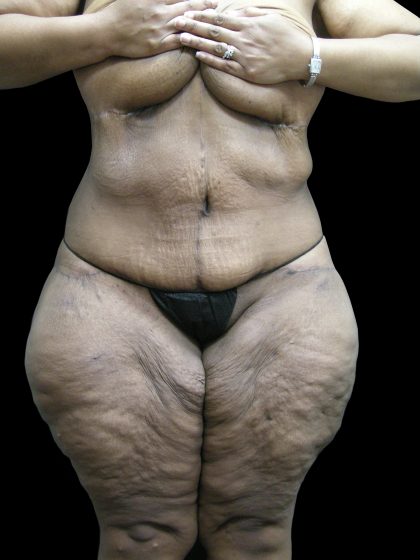 Post Weight Loss Before & After Patient #2749