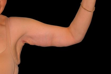 Arm Lift Before & After Patient #913